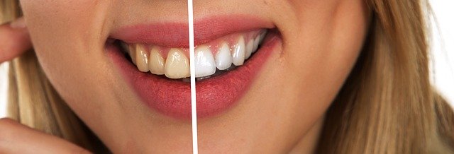 Before after picture of whitened teeth